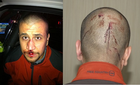 Police photo of George Zimmerman taken the night he killed Trayvon Martin from the State of Florida 9th Supplemental Discovery