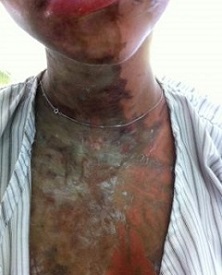  Katie Gee, one of two British teenagers attacked with acid in Zanzibar.