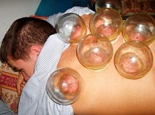getting treated with heated glasses - traditional Chinese medicine